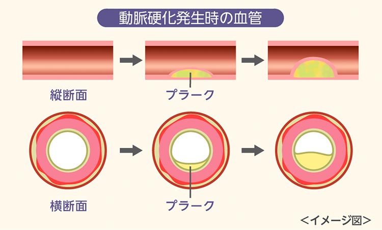 動脈硬化発生時の血管